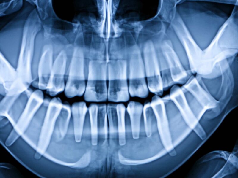 A woman has sued an Ocala dentist's office over a wisdom tooth extraction in which she allegedly broke her jaw because of a lack of adequate anesthesia.