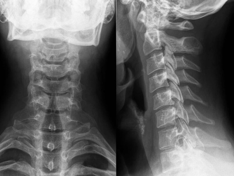 Xray of neck and spine
